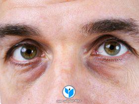 دلیل ایجاد حلقه های سیاه زیر چشم ها چیست، و چطور می توانیم آنها را برطرف کنیم