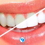 ۷ نکته برای داشتن دندانهایی سالم و سفید