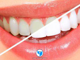۷ نکته برای داشتن دندانهایی سالم و سفید